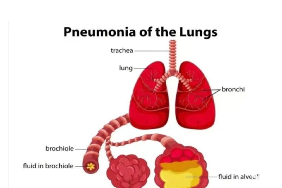 Dinkes Tanggamus: Warga perlu waspadai penyakit pneumonia
