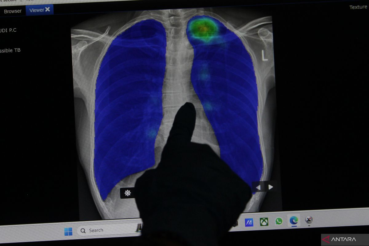 Dokter: Waspada tuberkulosis laten yang bisa timbul tanpa gejala