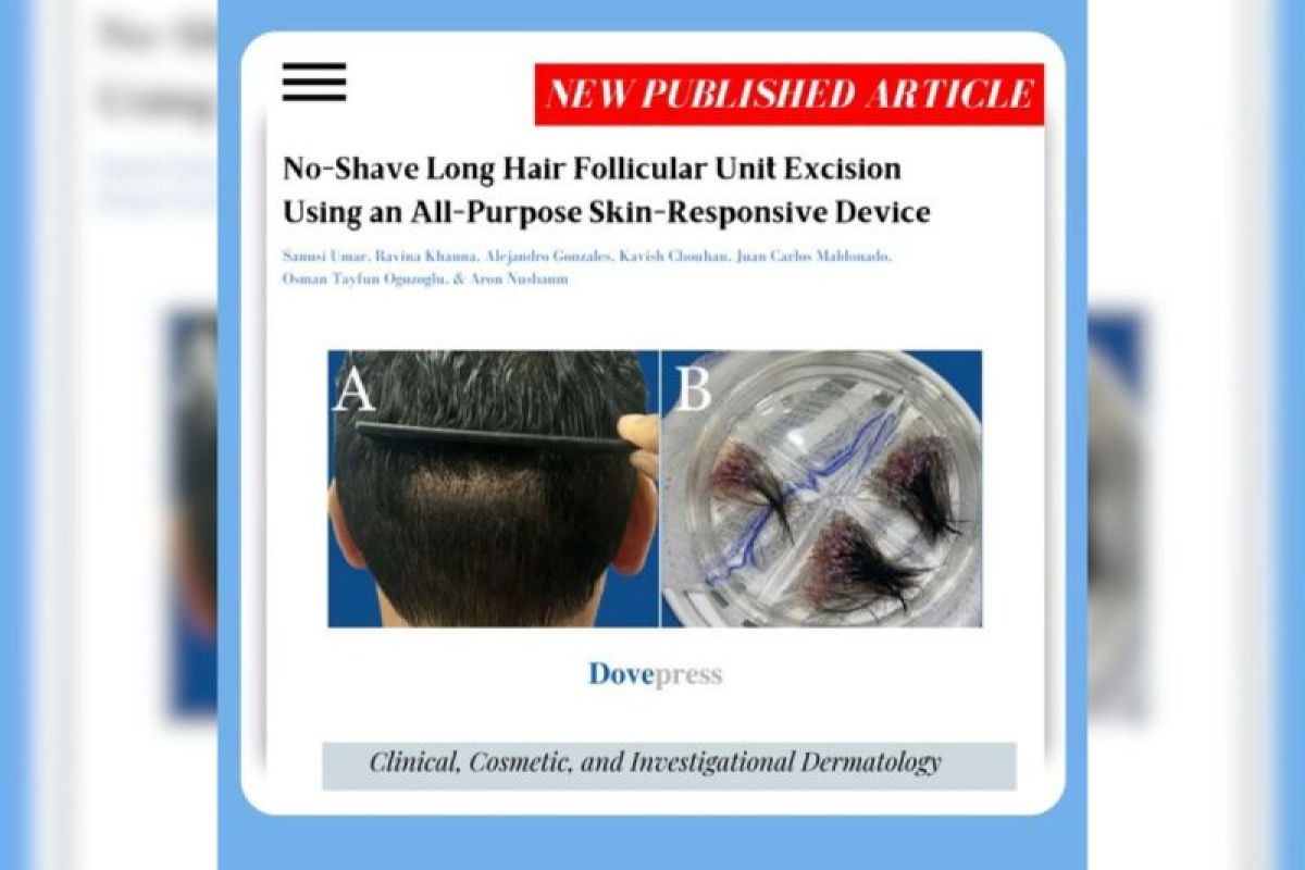 Novel Device Facilitates Successful No-Shave FUE Transplants for Long Hair with Ease