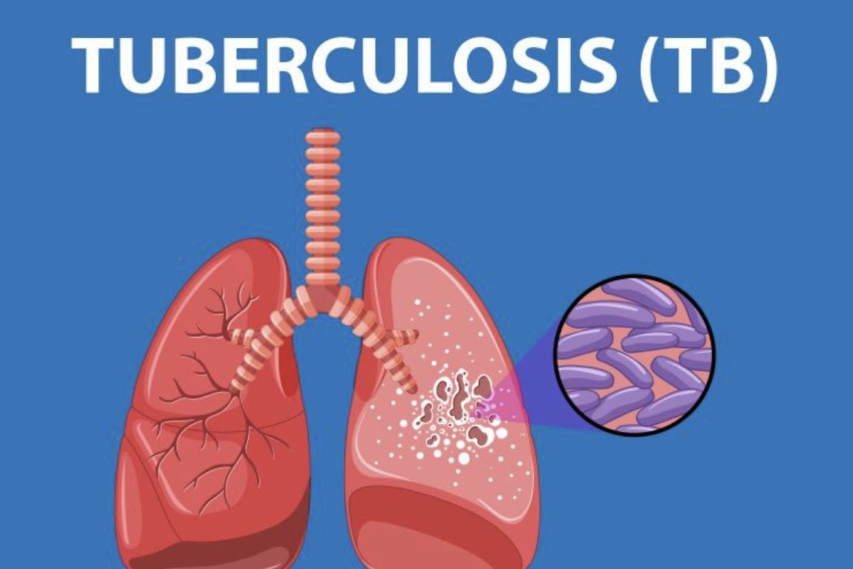 Dokter paparkan ciri-ciri batuk karena TBC