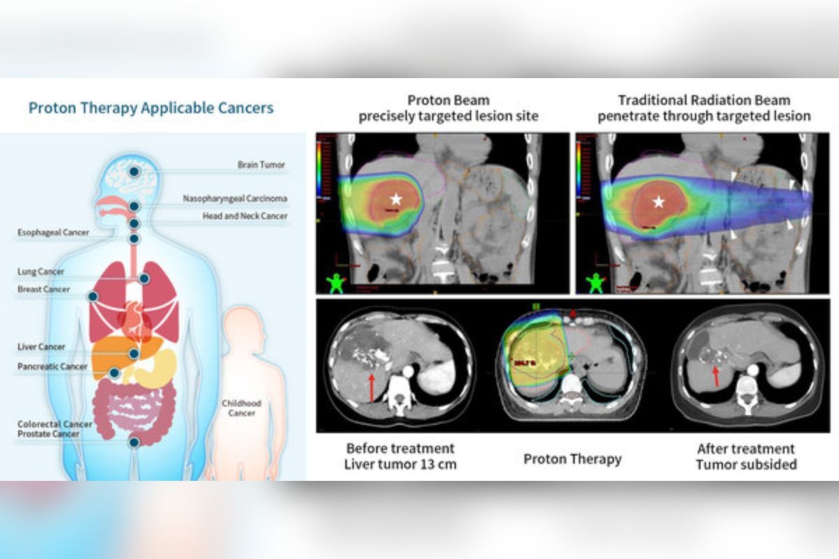 Terapi Proton untuk Penyakit Kanker di Rumah Sakit Chang Gung Hasilkan Terobosan Penting