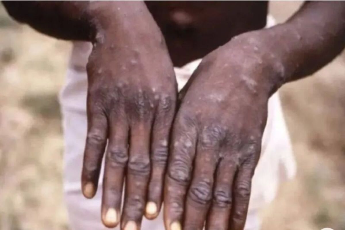 Zimbabwe records first two cases of monkey pox virus – ANTARA News West Kalimantan