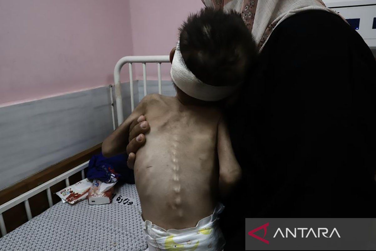 WHO: 57 anak Gaza meninggal kelaparan sejak blokade Israel