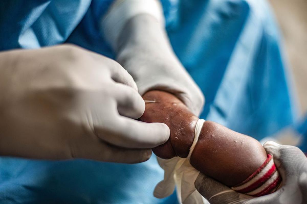 CDC Afrika: kematian akibat Mpox di Afrika lampaui 1.750 kasus