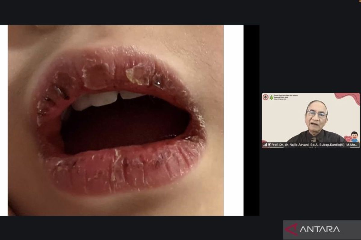 Waspadai gejala kawasaki pada anak yang sering salah diagnosis - ANTARA News Kalteng