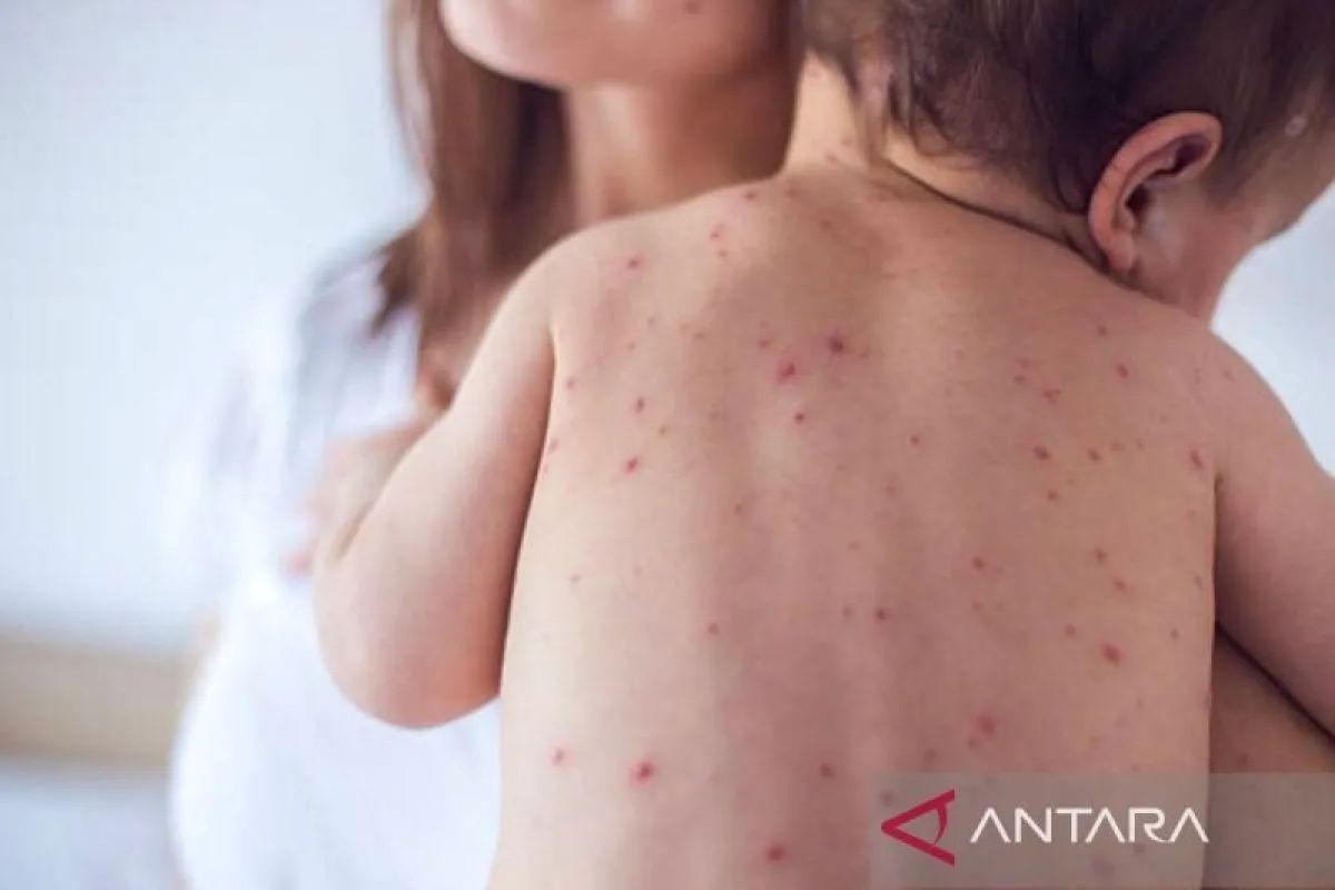 Kala campak mengintai balita