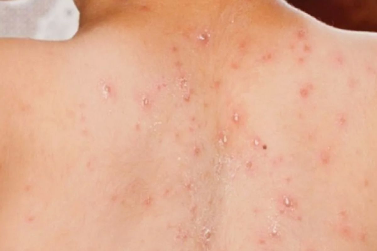 Campak dan difteri dinilai IDAI lebih darurat dibanding ancaman Hantavirus