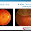 Usia 40 tahun ke atas rentan terkena ablasio retina