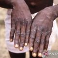 Govt prioritizing monkeypox vaccines for vulnerable groups: official