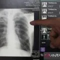 Di DPR, Kemenkes paparkan temuan kasus TBC 2024 dan pengobatannya