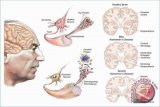 Mengantuk di siang hari bisa jadi alzheimer