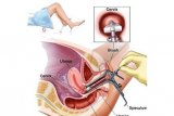 Dokter sebut terapi target membuat sel kanker jadi mudah dikendalikan