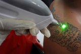 Petugas medis menggunakan sinar laser untuk menghapus tato seorang peserta dalam kegiatan 