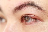 Hapus riasan mata kurang bersih akibatkan penyakit hordeolum