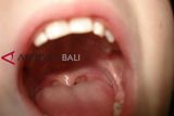 Waspada infeksi sekitar gigi, bisa jadi tanda kanker mulut