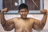 Aria permana (13) penyandang obesitas dengan berat badan mencapai 192 kg berpose menunjukkan tanganya pasca operasi pada tahun 2017 lalu di kampung Pasir Pining, Desa Cipurwasari, Tegalwaru, Karawang, Jawa Barat, Selasa (18/6/2019). Setelah menjalani operasi bariatrik pada tahun 2017 lalu berat badan Aria sekarang menjadi 85 kg dan akan melakukan operasi lanjutan untuk menghilangkan gelambir kulit yang ada di bagian tubuhnya. Sebelumnya berat badan Aria mencapai 192 kg. ANTARA JABAR/M Ibnu Chazar/agr