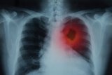 Sekitar 88 persen pasien kanker paru wafat tahun yang sama kankernya ditemukan