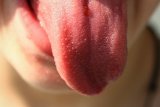 Hati-hati, sariawan bisa menjadi tanda awal kanker lidah