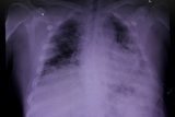 Dokter sebut sulit bedakan pneumonia karena COVID-19 atau bakteri