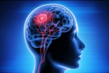 Sakit kepala yang semakin berat bisa jadi indikasi tumor otak, ini saran dokter