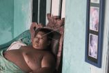 Penderita obesitas Rafka Adiputra (11) saat beristirahat di kediamannya di Desa Kedung Pengawas, Babelan, Kabupaten Bekasi, Jawa Barat, Kamis (10/3/2022). Rafka mengalami obesitas dari umur dua tahun dan saat ini berat badannya mencapai 115 kg. ANTARA FOTO/Fakhri Hermansyah/YU.