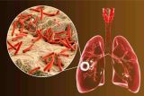 Dokter: Perokok punya risiko tinggi terkena TBC