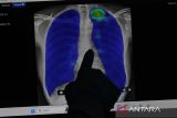 Dokter luruskan beberapa mitos seputar paru-paru basah