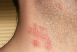 Health Ministry pushes collaboration to boost shingles vaccination