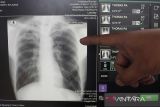 Di DPR, Kemenkes paparkan temuan kasus TBC 2024 dan pengobatannya