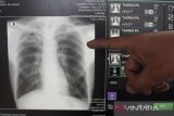TBC di Indonesia: 125 ribu kasus kematian setiap tahun