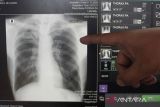 Menkes: Banyak pasien gagal sembuh TBC