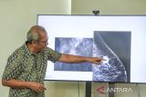 Dokter spesialis bedah konsultan onkologi Eka Hospital Sonar Soni Panigoro memberikan pemaparan terkait kanker payudara di Tangerang Selatan, Banten, Senin (6/10/2025). ANTARA FOTO/Galih Pradipta