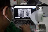 Dokter: Batuk lama hingga berat badan turun bisa jadi gejala awal TBC