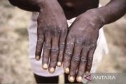 Cacar Air cuma sekali seumur hidup? Ini fakta di balik infeksi Varicella-zoster