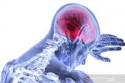 Atrial fibrilasi dan gejala awal yang berisiko picu stroke