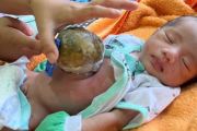 Kelainan usus, bayi dari pengembala Pandeglang butuh bantuan donatur