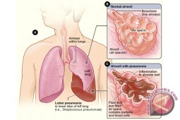 Pasien Dispepsia Dan TBC Meningkat Di Kotabaru