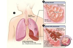 Sembilan Orang Meninggal Karena Paru