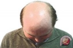 Kebotakan Dini Ada Kaitan Dengan Risiko Kanker Prostat