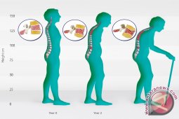 Wanita Masih Menganggap Osteoporosis karena Lanjut Usia