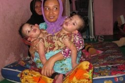 Bayi Kembar Siam Kediri