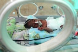 Kondisi Bayi Kembar