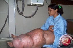 Pemerintah Bangka Canangkan Eliminasi Kaki Gajah