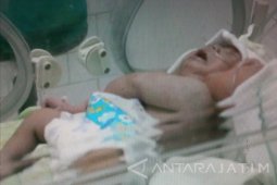 Bayi Dengan Kepala Dua di Gresik Meninggal