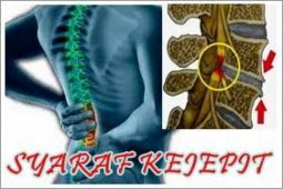 Dokter spesialis ortopedi sebut ergonomi penting guna cegah "overuse syndrome"