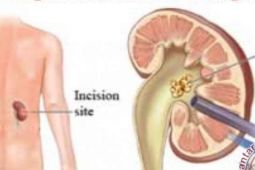 Dokter: Terlalu lama duduk dapat sebabkan batu ginjal