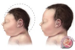 Penelitian: virus zika bisa ditularkan melalui air mata
