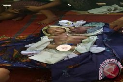 Bayi Kembar Siam Berkepala Dua Itu Meninggal
