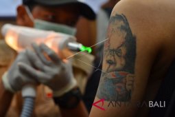 Layanan Hapus Tato Gratis