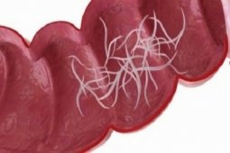 Balita Sukabumi meninggal karena cacing gelang, begini penjelasannya!